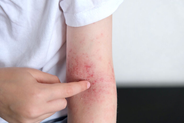 Eczema الإكزيما مرض مزمن