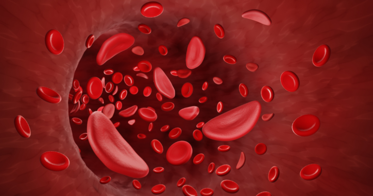 sickle cell disease مرض سكلر
