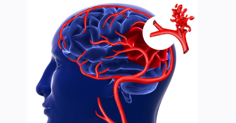 علاج تمدد الأوعية الدموية في الدماغ