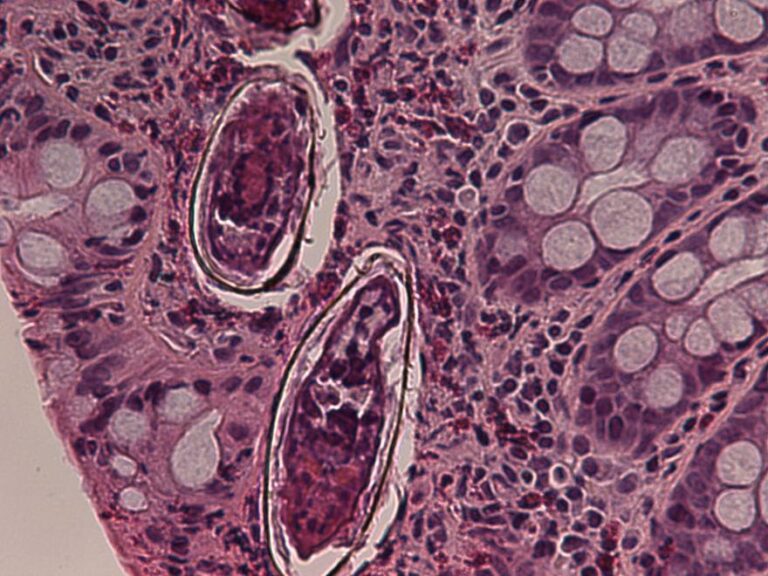 مرض البلهارسيا (Schistosomiasis)