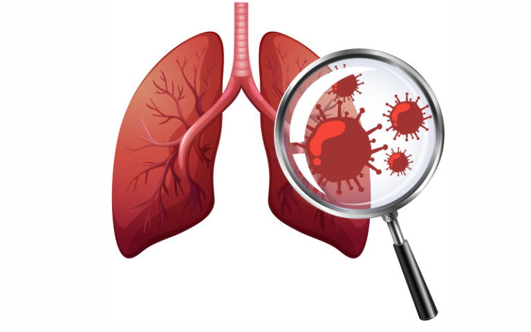 مرض ذات الرئة (Pneumonia)
